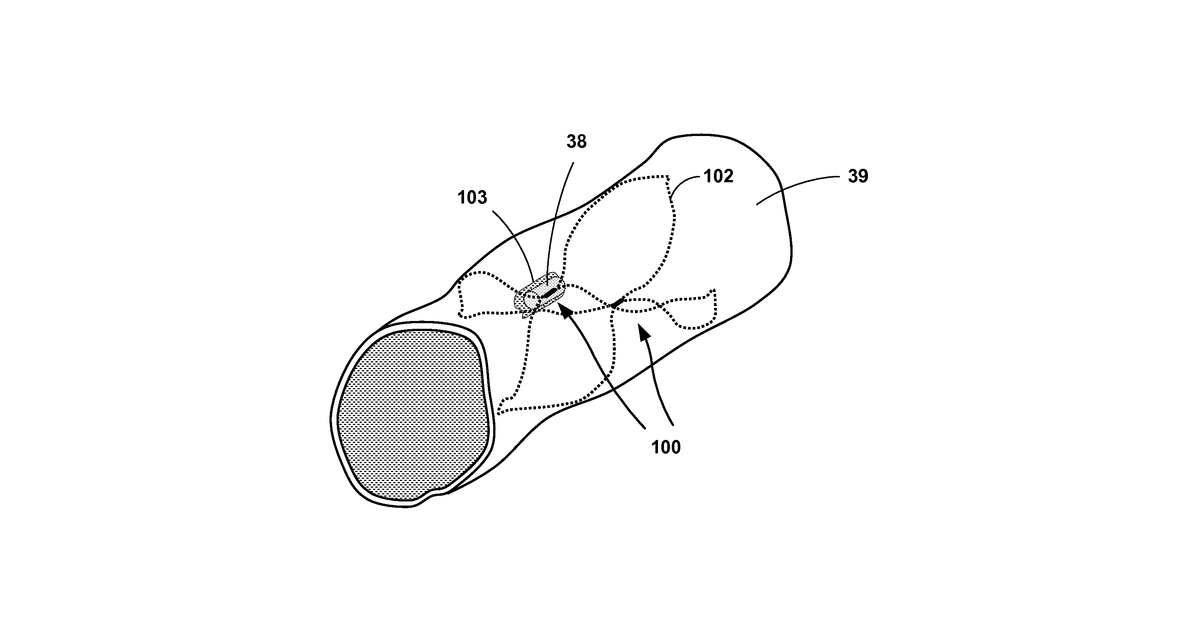 Patent drawing for Medical device fixation