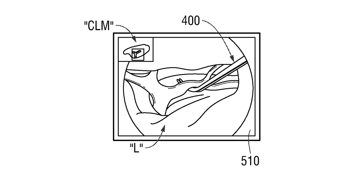 Patent drawing for Systems and methods for providing assistance during surgery