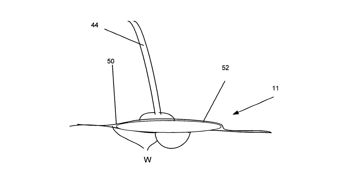 Patent drawing for Method and device for providing intermittent negative pressure wound healing