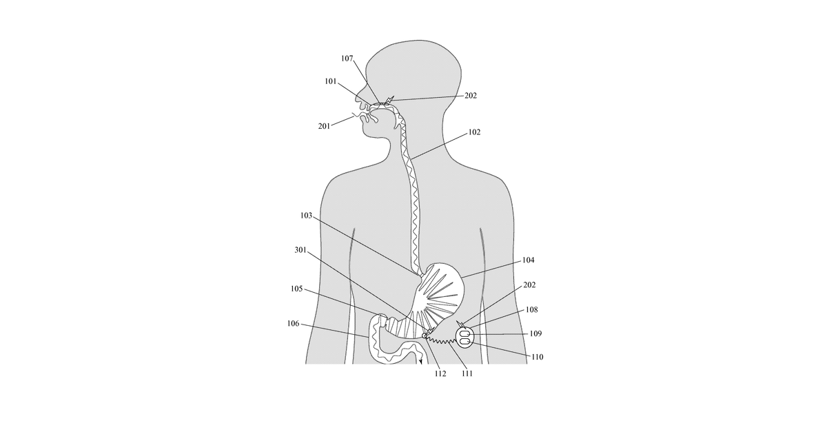 Patent drawing for Selectively Reducing Excess Consumption and/or Absorption of Unhealthy Food using Electrical Stimulation